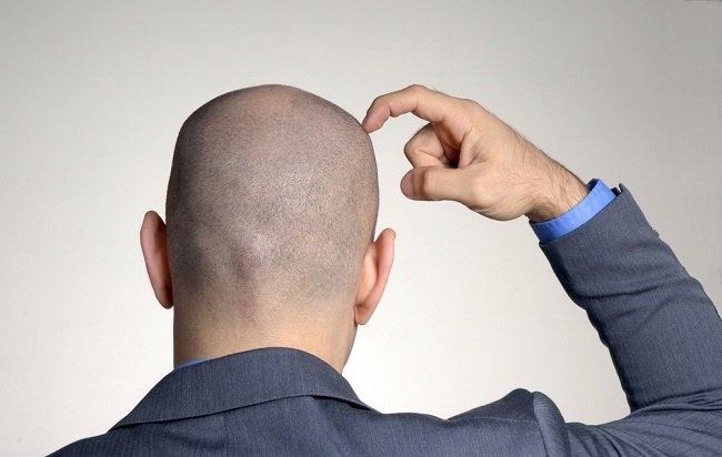 Ντροπή για το φαλακρό κεφάλι; Δοκιμάστε τη Μεταμόσχευση Μαλλιών