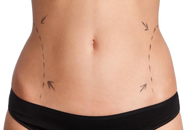 Lær de forskellige former for fedtsugning at kende for at få den ideelle kropsform