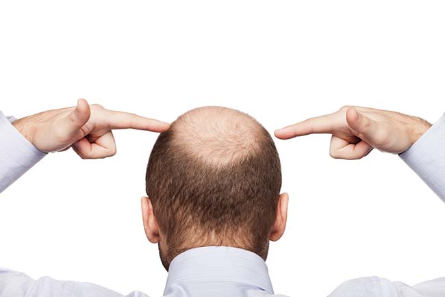 Kend årsagerne og hvordan man forebygger skaldede hoveder hos mænd