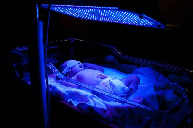 Kollaste imikute fototeraapia eelised
