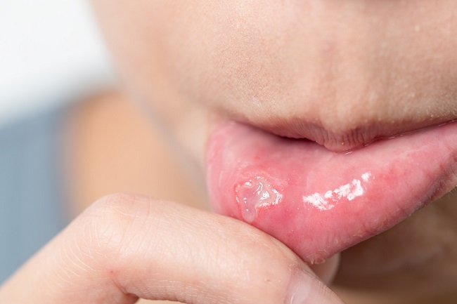 Get to know the causes of canker sores that are often not realized