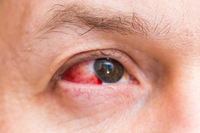 Sarkani plankumi acīs subkonjunktīvas asiņošanas dēļ, šie ir cēloņi un ārstēšana