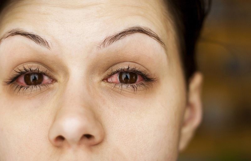 آنکھوں کی سوزش کی اقسام اور اس پر قابو پانے کا طریقہ