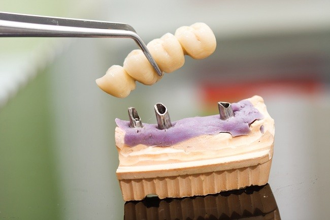 Forståelse af tandimplantatinstallationsprocessen og dens risici