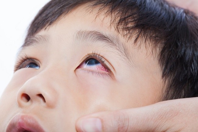Klager over kløende øjne på grund af allergi
