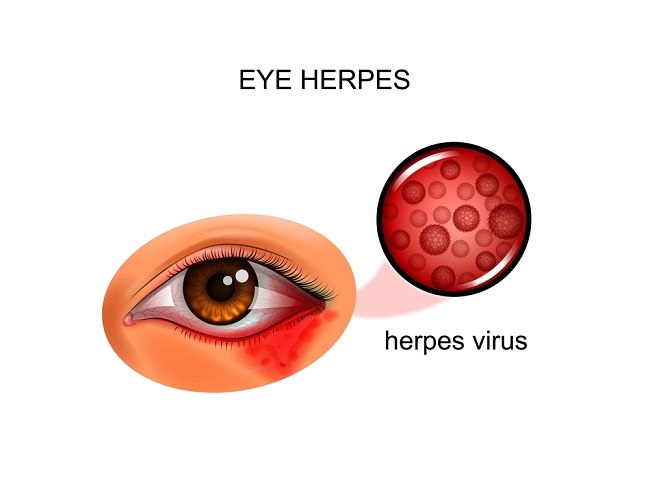 Genkend symptomerne på herpes i øjnene og behandling