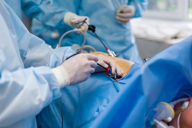 Galdeblærefjernelseskirurgi med laparoskopi, her er hvad du bør vide
