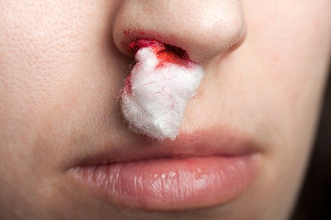 Gå ikke i panik, når du oplever næseblod, også kaldet næseblod