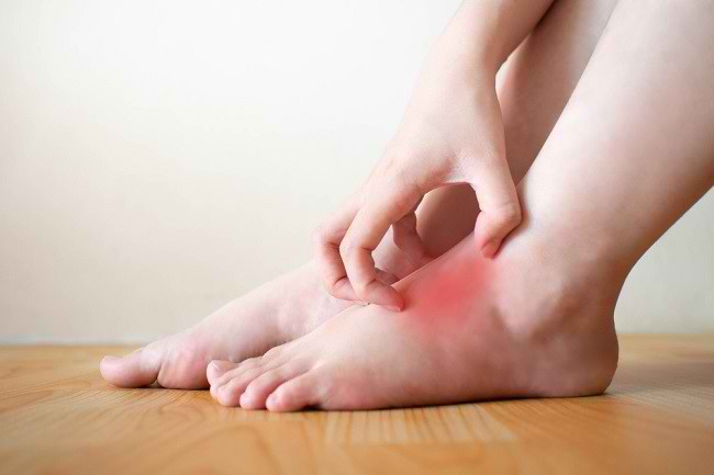 5 bệnh về da ở bàn chân bạn cần biết