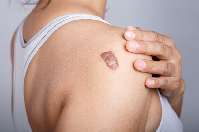 Forskellige typer ar på huden og hvordan man overvinder dem