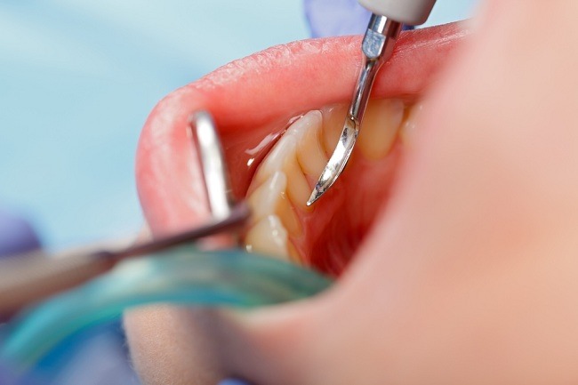 Hva er effekten av tannstein og hvordan kan man forhindre det?