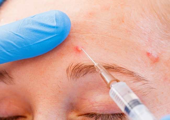 Acne-injektioner for at overvinde genstridig acne