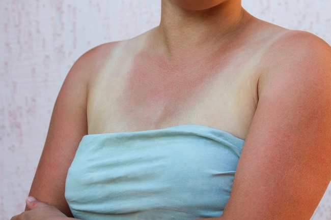 Atpažinkite skirtumą tarp alergijos saulei (saulės bėrimų) ir saulės nudegimų (saulės nudegimų)