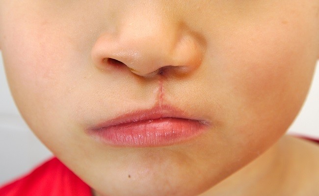 Asjad, mida peate huulelõhede kirurgia kohta teadma