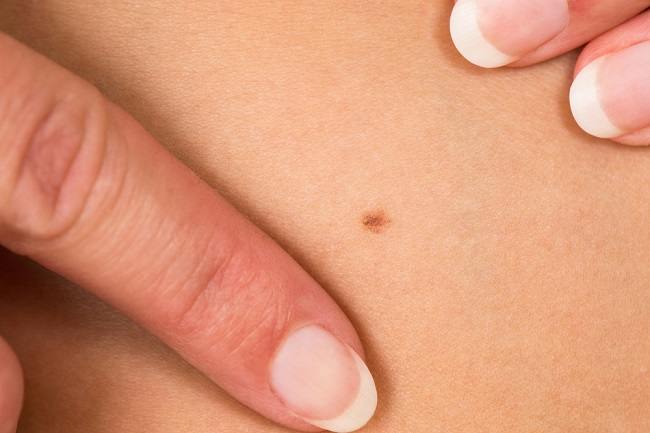 Get to know the difference between a normal mole and cancer