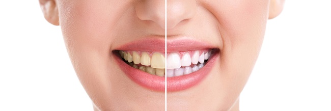 Know What is Teeth Whitening