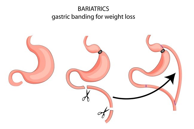 Bariaatriline kirurgia: tüübid, eelised ja riskid