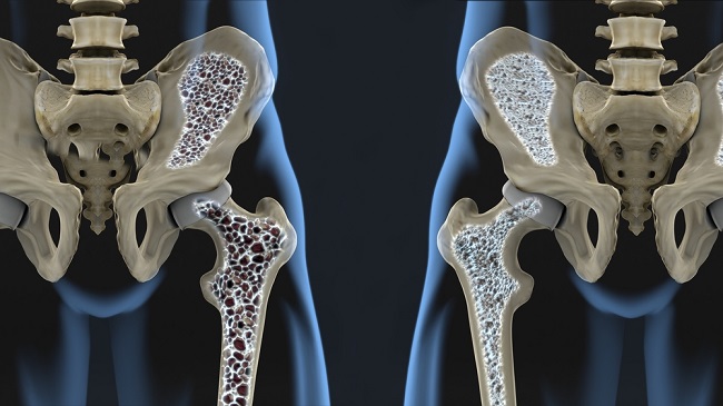 Kend typerne af osteoporose og hvordan man forebygger det