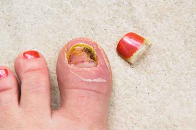 Causes of Yellow Nails Syndrome and Treatment