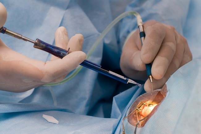 Kirurgi er stadig den mest effektive medicin mod grå stær