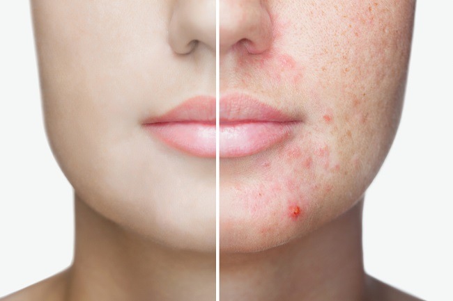 Lær hyperandrogen acne at kende og hvordan man behandler det